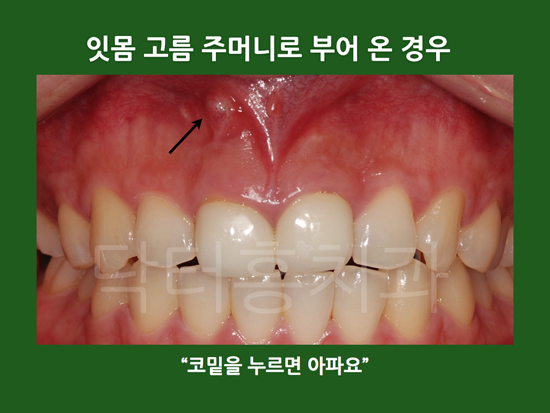 앞니 잇몸 염증 고름주머니 생긴 경우, 치료는? : 네이버 블로그